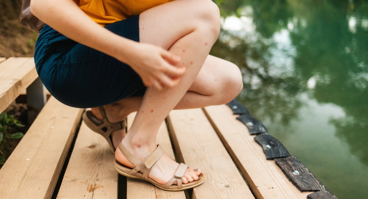 Mosquito Bites Woman Squatting