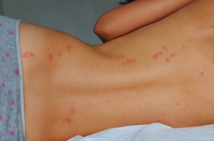 Bites