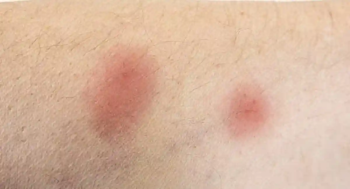 spider bites on human arm skin